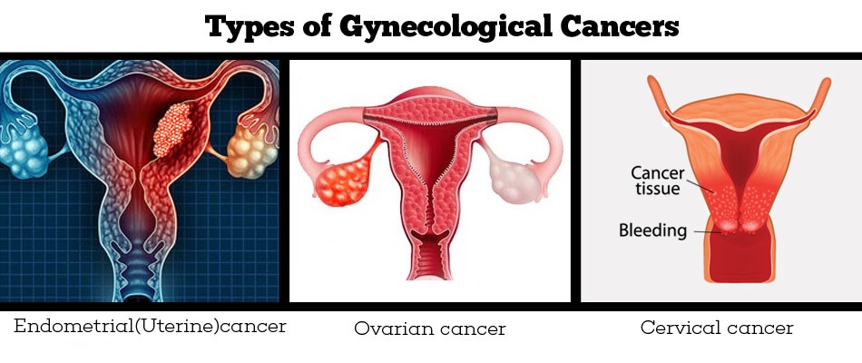types of gynecological cancers