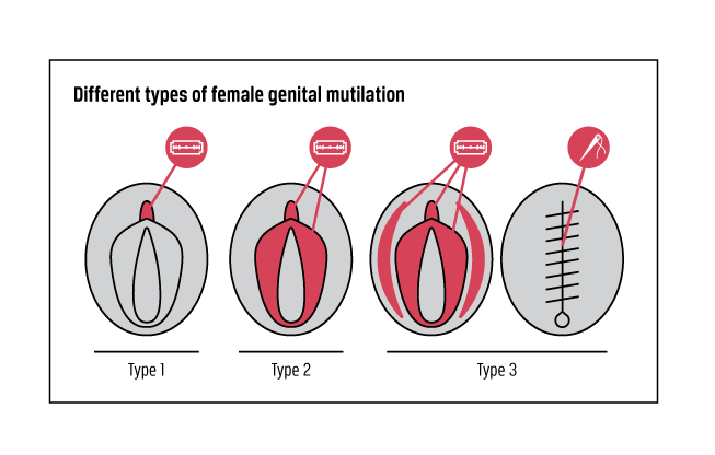 FGM types 02