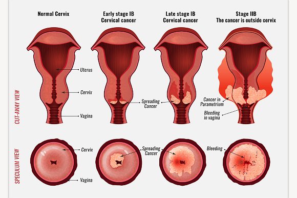 cervical cancer 01